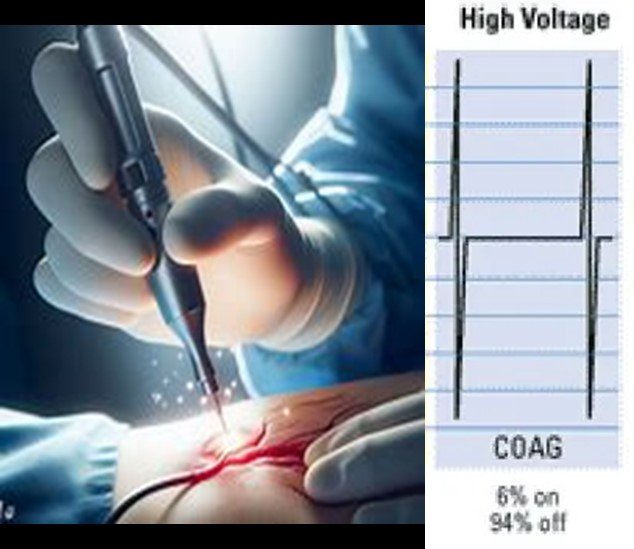 Modo coagulación en electrocirugía