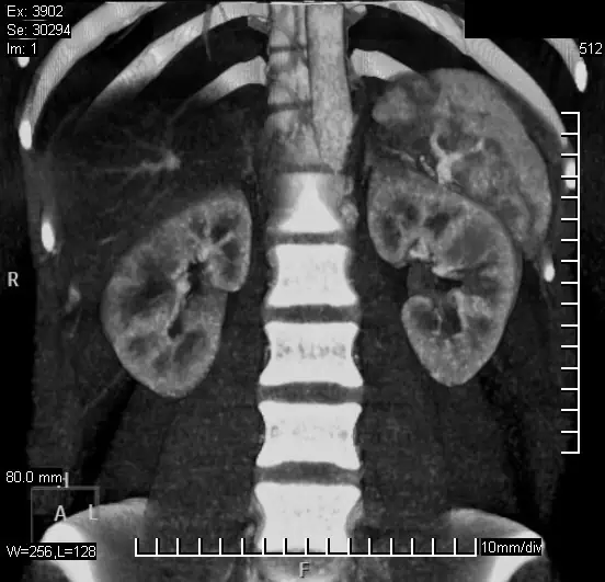 Tomografia computada renal